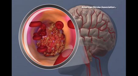 COVID-19 Diindikasi Tingkatkan Stroke Usia Muda, Mengapa Virus Paru Serang Otak?