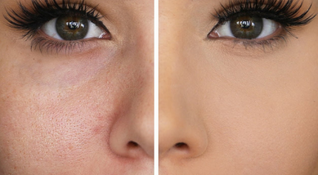 Kecilkan Pori dengan Es Batu, Efektifkah?